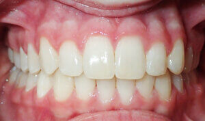 After: Patient with deep overbite