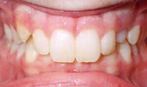 Before: Patient with deep overbite