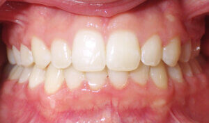 After: Patient with deep bite (overbite) and mild crowding