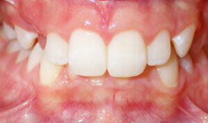 Before: Patient with deep bite (overbite) and mild crowding