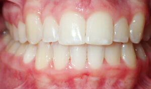 After: Patient with deep bite (overbite) and crowding