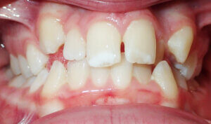 Before: Patient with deep bite (overbite) and crowding