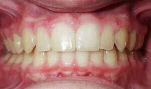 After: Patient with deep bite (overbite) and crowding