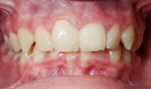 Before: Patient with deep bite (overbite) and crowding
