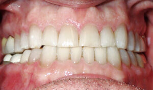 After: Patient with spacing edge to edge bite