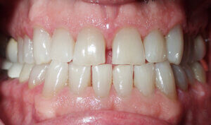 Before: Patient with spacing edge to edge bite