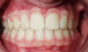 After: Patient with openbite