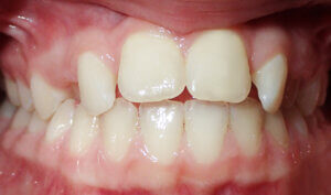 Before: Patient with openbite