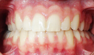 After: Patient with moderate crowding and deep overbite