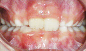 Before: Patient with moderate crowding and deep overbite