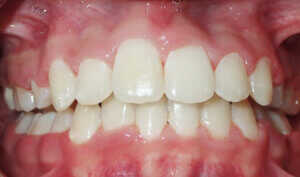 After: Patient with severe crowding