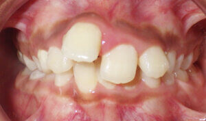 Before: Patient with severe crowding